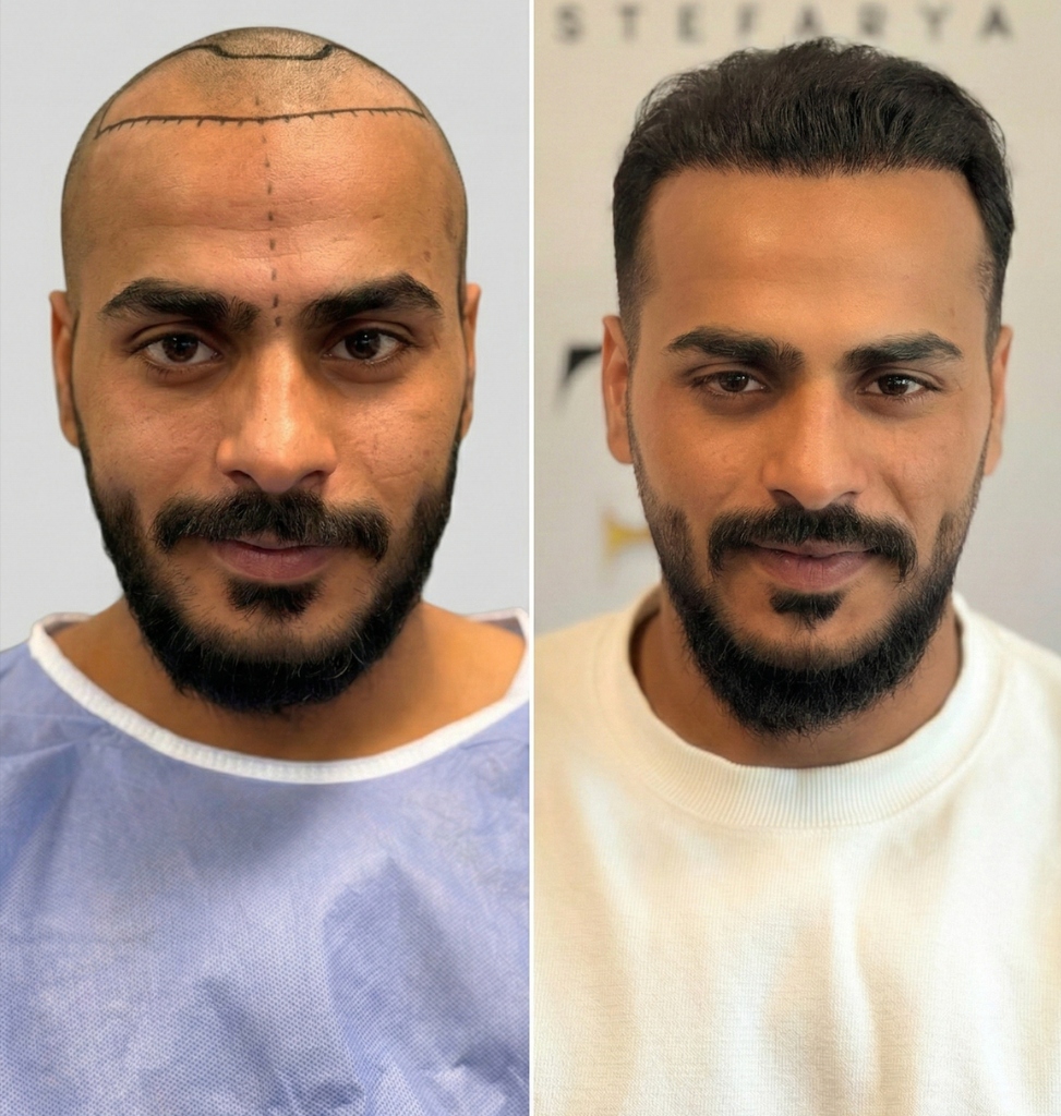 Before and After - Patient 1