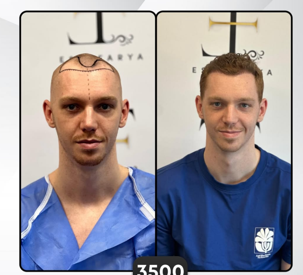 Before and After - Patient 2